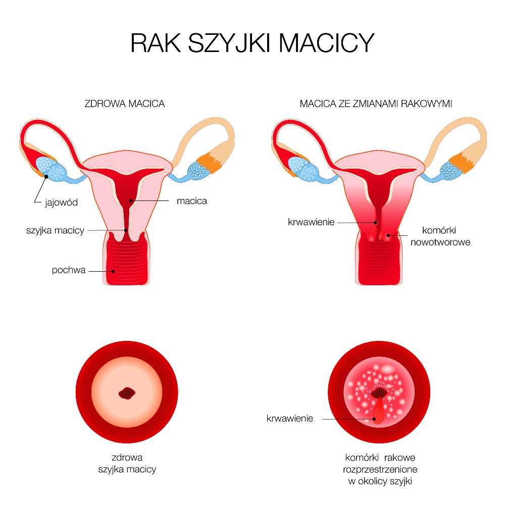 rak szyjki macicy.jpg